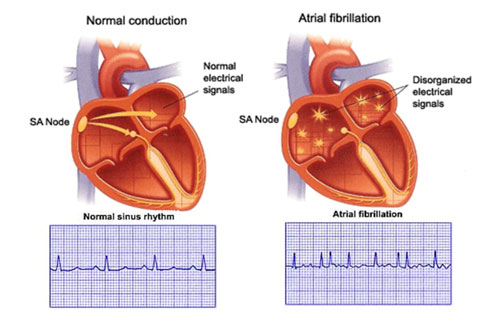 Atrial Fibrillation – Athens Cardiac